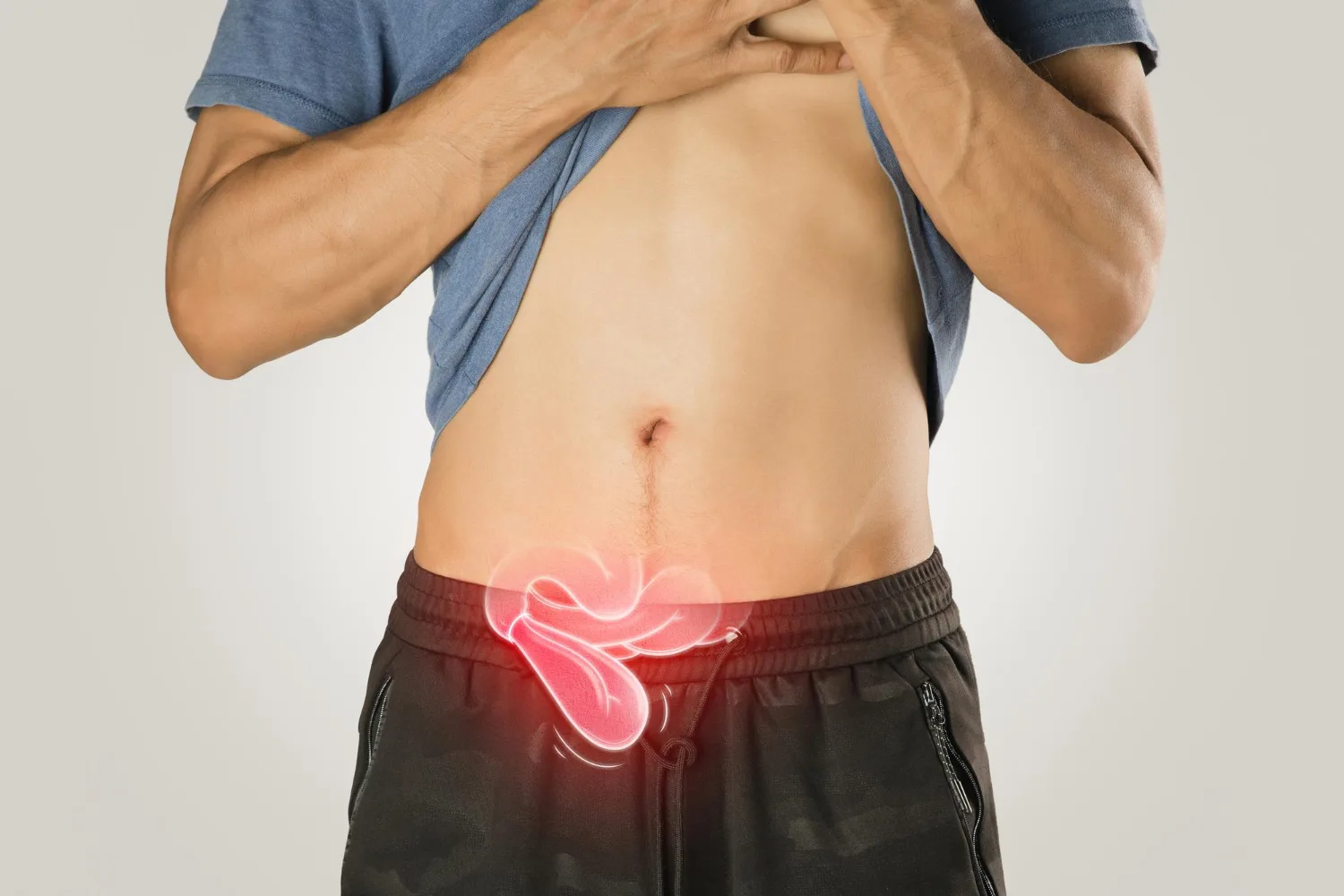 Tratamiento avanzado para hernia inguinal en CDMX y Edo. Mex. con cirugía de mínima invasión